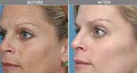 laser mole removal face